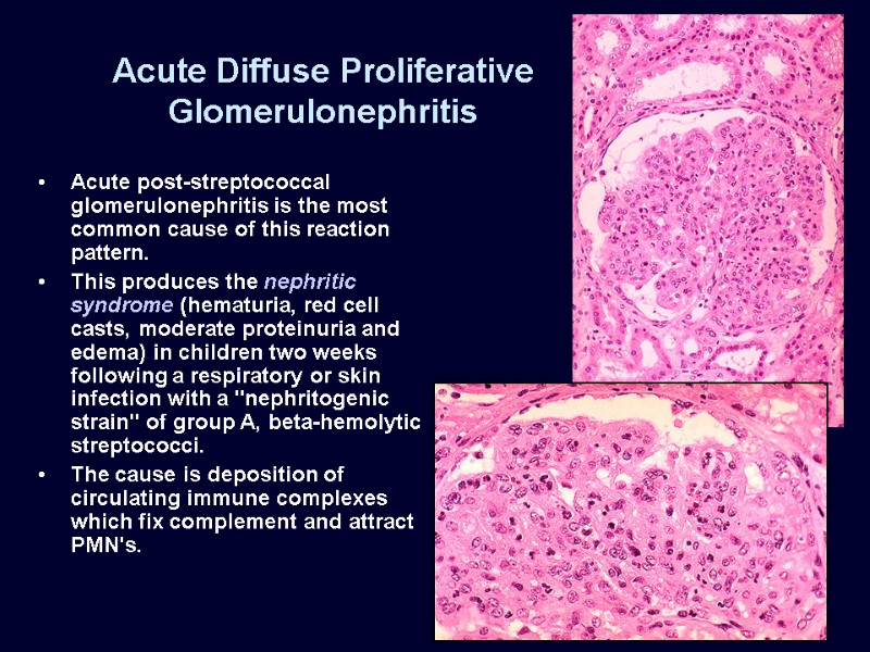 Acute Diffuse Proliferative Glomerulonephritis Acute post-streptococcal glomerulonephritis is the most common cause of this